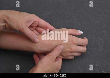 main montrant un poignet avec cicatrice chirurgicale après ablation d'un kyste ganglionnaire. cicatrisation de la peau et de la cicatrice, avec un léger gonflement autour du poignet. récupération après Banque D'Images