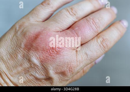 Main féminine avec des taches pigmentaires sur la peau, doigt gonflé par piqûre d'insecte. réaction allergique à la piqûre d'insecte. gros plan sur la plaie par morsure enflée Banque D'Images
