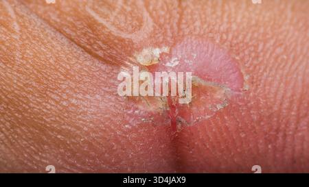 La peau humaine montre une cloque rouge douloureuse et cicatrisation de la plaie, indiquant une blessure, une brûlure ou une irritation, avec une peau écaillée sèche et une nouvelle chair rose sur le surf Banque D'Images