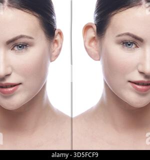 La fille avant et après chirurgie plastique cosmétologique. Résultat de l'opération du problème. Procédé de retrait d'un patient en soins de santé. Traitement esthétique humain. Femelle p Banque D'Images
