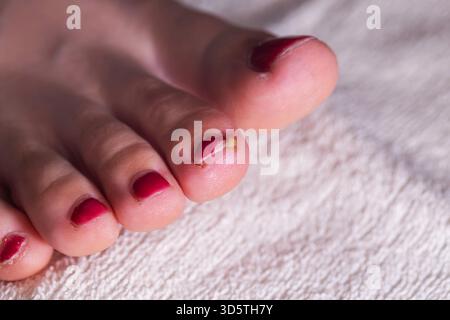 Un regard attentif sur un pied avec une pédicure de vernis à ongles rouge montrant un orteil infecté. L'orteil semble gonflé et a une petite tache jaune. Serviette douce pour le service Banque D'Images