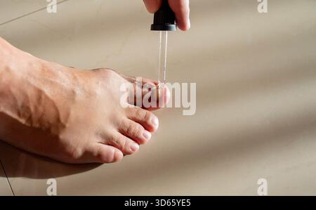 Champignon des orteils et des ongles. Dermatologue. Le médecin traite les pieds du patient. Banque D'Images