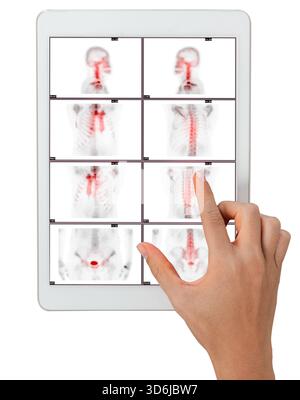 Main interagissant avec la tablette affichant des acquisitions PET CT. L'imagerie diagnostique Multiview met en évidence une activité métabolique anormale. Idéal pour le médical, l'oncolog Banque D'Images