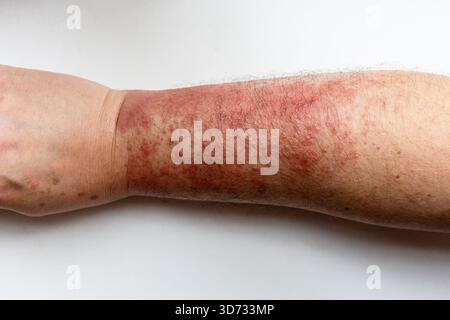vue de dessus de l'avant-bras masculin avec dermatite allergique sur la peau de la main Banque D'Images