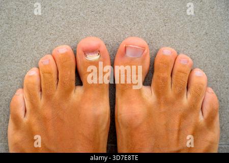 Enlevé vieux ongle tombé gros ongle orteil après blessure mécanique endommagée sous l'ongle. Traumatisme des ongles du gros orteil. Un podiatre travaille malade Banque D'Images