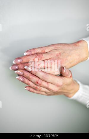 Vue rapprochée des mains touchées par l'eczéma, la dermatite de contact et le psoriasis. La peau semble sèche et irritée, avec des rougeurs visibles et une tache rugueuse Banque D'Images
