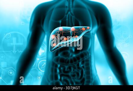 Attaque virale sur le foie humain. illustration 3d. Banque D'Images