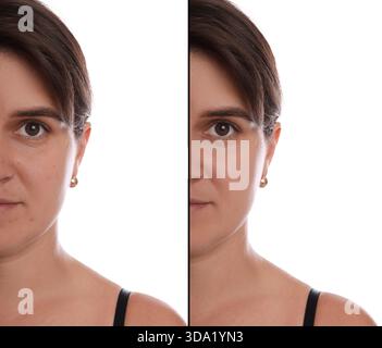 Femme montrant sa peau avant et après le traitement cosmétique. Collage sur fond blanc Banque D'Images