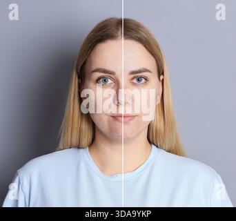 Femme montrant sa peau avant et après le traitement cosmétique. Collage sur fond gris Banque D'Images