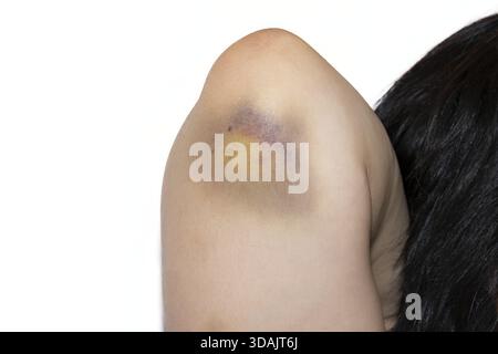 Gros plan d'une grande ecchymose ou d'un hématome sur le coude montrant plusieurs étapes de cicatrisation et une décoloration Banque D'Images