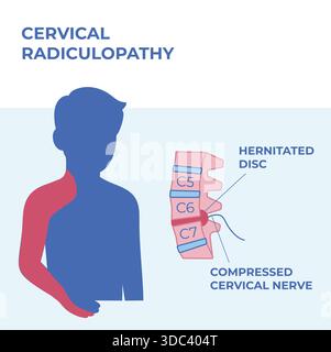 Illustration vectorielle médicale montrant la radiculopathie cervicale causée par une hernie discale, avec compression nerveuse mise en évidence et zones de douleur rayonnantes Illustration de Vecteur