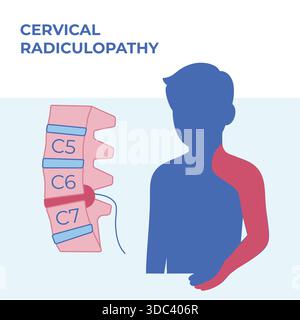 Illustration médicale vectorielle de radiculopathie cervicale montrant une hernie discale et les zones de douleur correspondantes dans le cou, l'épaule et le membre supérieur. Illustration de Vecteur