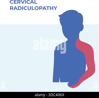 Illustration vectorielle montrant les zones de distribution de la douleur associées à la radiculopathie cervicale, mettant en évidence les régions du cou, de l'épaule et du bras. Simplifié Illustration de Vecteur