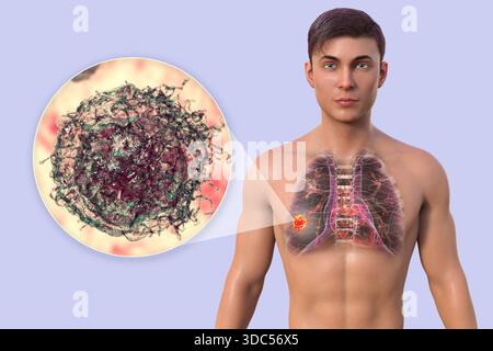 Illustration par ordinateur d'un homme à la peau transparente, révélant la présence d'un cancer du poumon, et vue rapprochée des cellules cancéreuses. Banque D'Images