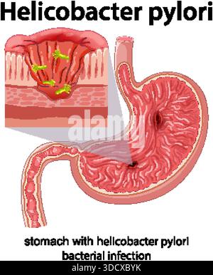 Illustration vectorielle médicale de l'estomac avec infection à Helicobacter pylori, coupe transversale détaillée, étiquetée Illustration de Vecteur