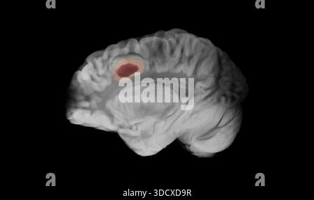 Vue sagittale d'un cerveau humain en niveaux de gris montrant un glioblastome comme une masse marron foncé avec un halo rose pâle dans le lobe frontal gauche contre un blac Banque D'Images