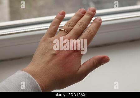 Éruption allergique sur la main Banque D'Images