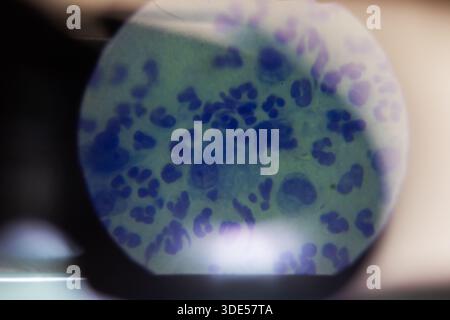 observation au microscope de cellules colorées sous la lentille révélant des amas violets de leucocytes sur lame de verre, ambiance de laboratoire clinique, Banque D'Images