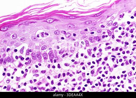Tumeur à lymphome T cutané, cancer cutané au microscope Banque D'Images