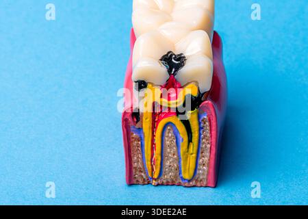Modèle dentaire montrant des caries dentaires graves et des problèmes canalaires Banque D'Images
