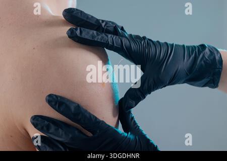 Le clinicien effectue un aiguilletage sec stérile sur l'épaule pour soulager la douleur, la mobilité et la réadaptation sportive. Banque D'Images