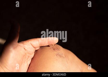 Doigt avec une goutte de crème, hydratant l'eczéma sur le genou. Banque D'Images