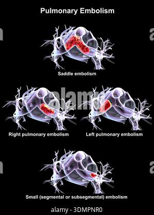 Embole Microscope Illustration d'une embolie pulmonaire segmentaire, montrant une embole ...