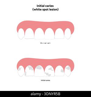 Infographie dentaire dessinée à la main illustrant la lésion initiale de la tache blanche de la carie. Montre la déminéralisation de l'émail, les couches dentaires, les changements de surface de l'émail Banque D'Images
