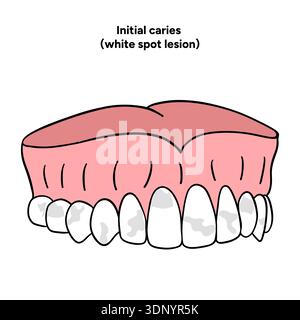Infographie dentaire dessinée à la main illustrant la lésion initiale de la tache blanche de la carie. Montre la déminéralisation de l'émail, les couches dentaires, les changements de surface de l'émail Banque D'Images