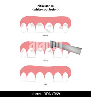 Infographie dentaire dessinée à la main illustrant la lésion initiale de la tache blanche de la carie. Montre la déminéralisation de l'émail, les couches dentaires, les changements de surface de l'émail Banque D'Images