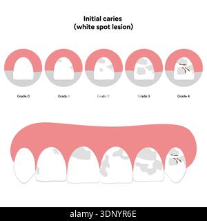 Infographie dentaire dessinée à la main illustrant la lésion initiale de la tache blanche de la carie. Montre la déminéralisation de l'émail, les couches dentaires, les changements de surface de l'émail Banque D'Images