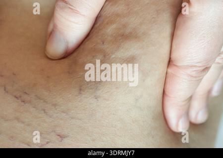 Gros plan de la cellulite et des vergetures sur la peau féminine caucasienne avec le toucher de la main Banque D'Images