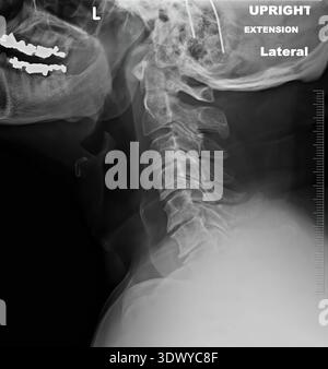 Radiographie de vue latérale de la tête et du cou d'un humain révélant le crâne, l'os de la mâchoire, les dents et la colonne cervicale étendue, utilisée pour diagnostiquer les problèmes squelettiques et Banque D'Images