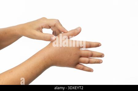 Main gonflée d'une allergie aux piqûres d'insectes. Soins allergiques à la peau. Banque D'Images