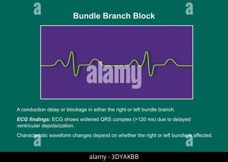 Illustration d'un électrocardiogramme (ECG) dans un bloc de branche (BBB). Ceci montre un élargissement caractéristique du QRS et une modification du schéma de conduction ventriculaire. Banque D'Images