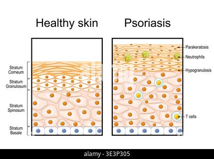 Psoriasis. Différence entre épiderme normal et épiderme psoriasique avec parakératose et hypogranulose. Comparaison peau saine et psoriasique Illustration de Vecteur