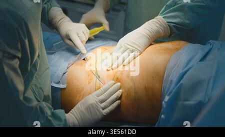 Fermez deux médecins méconnaissables hommes chirurgiens faisant délicate opération de chirurgie du ventre abdominale liposuccion médecins hommes travaillant dans la médecine Banque D'Images