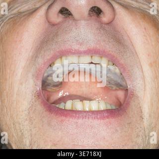 Macro gros plan d'un protège-dents en plastique pour arrêter l'usure due au grincement des dents la nuit. Souvent causé par la tension et l'inquiétude. Garde dans la bouche d'un mâle senior w Banque D'Images