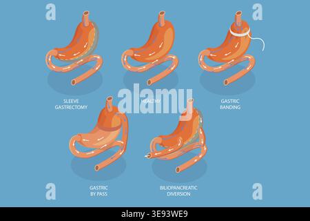 Vecteur plat isométrique 3D illustration conceptuelle des types de chirurgie bariatrique, gastrectomie de manchon Banque D'Images