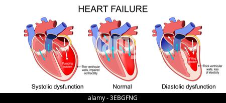Insuffisance cardiaque. Section transversale du coeur humain. Dysfonction diastolique, dysfonction systolique. Problème de remplissage et problème de pompage du système circulatoire. V Illustration de Vecteur