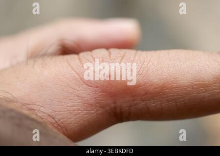 Gros plan macro montrant une peau rouge gonflée sur un doigt humain souffrant de douleurs douloureuses causées par une piqûre d'insecte et une marque de piqûre d'abeille visible Banque D'Images
