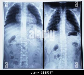 Imagerie radiographique détaillée montrant la structure du thorax et les anomalies possibles de la colonne vertébrale humaine Banque D'Images