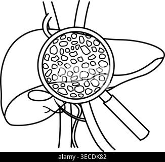 Maladie du foie pour Coloring page. Cirrhose du foie sous loupe. Illustration vectorielle d'organes humains. Anatomie et médecine Illustration de Vecteur