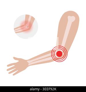 Illustration vectorielle plate montrant la douleur articulaire du coude, l'anatomie osseuse, l'inflammation et les concepts de soins orthopédiques dans un style médical propre. Illustration de Vecteur