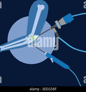 Illustration vectorielle plate de la chirurgie d'arthroscopie du coude avec instruments orthopédiques, anatomie et concepts de soins médicaux modernes. Illustration de Vecteur