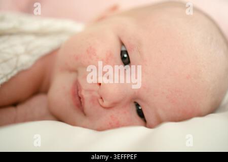Un adorable nouveau-né avec une peau délicate, une éruption cutanée d'adaptation et de minuscules taches rouges. Le bébé est allongé sur un tissu blanc doux, exsudant la chaleur, l'amour et le processus naturel d'ajustement de la peau. Banque D'Images