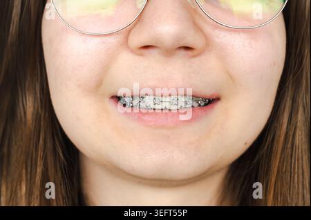Adolescent examinant la progression du traitement orthodontique tout en tenant un aligneur clair dans la main, auto-évaluation du parcours de redressement des dents et des soins dentaires Banque D'Images