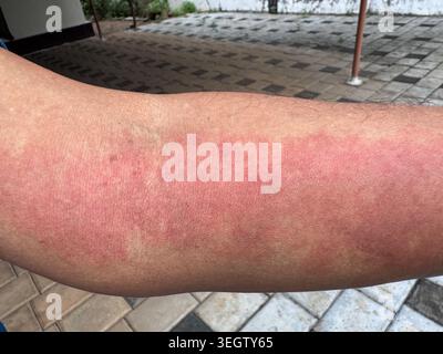 Gros plan d'une éruption cutanée rouge sévère sur un bras humain. Symptôme de réaction allergique, urticaire, dermatite ou inflammation sur la peau. Banque D'Images