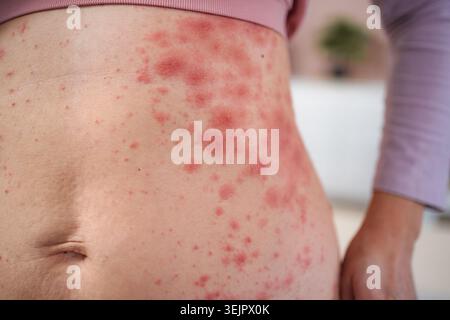 Femme éprouvant une éruption cutanée sur l'abdomen de réaction allergique Banque D'Images