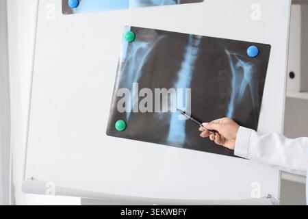 Main du médecin féminin et radiographie des poumons sur le tableau de conférence en clinique, gros plan Banque D'Images